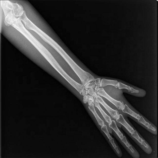 صورة أشعة للذراع - تصوير منزلي